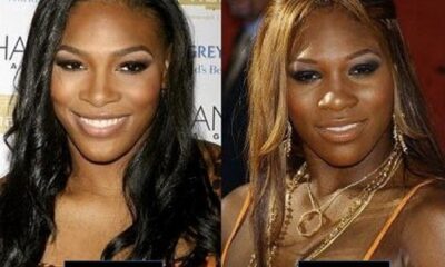 Serena Williams plastic surgery before and after