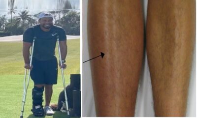 Tiger Woods Has Rod, Pins, Screws Put In Leg After Multiple Fractures and significant injuries
