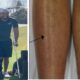 Tiger Woods Has Rod, Pins, Screws Put In Leg After Multiple Fractures and significant injuries