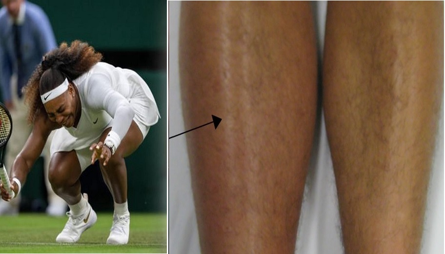 Serena Williams Wimbledon injury