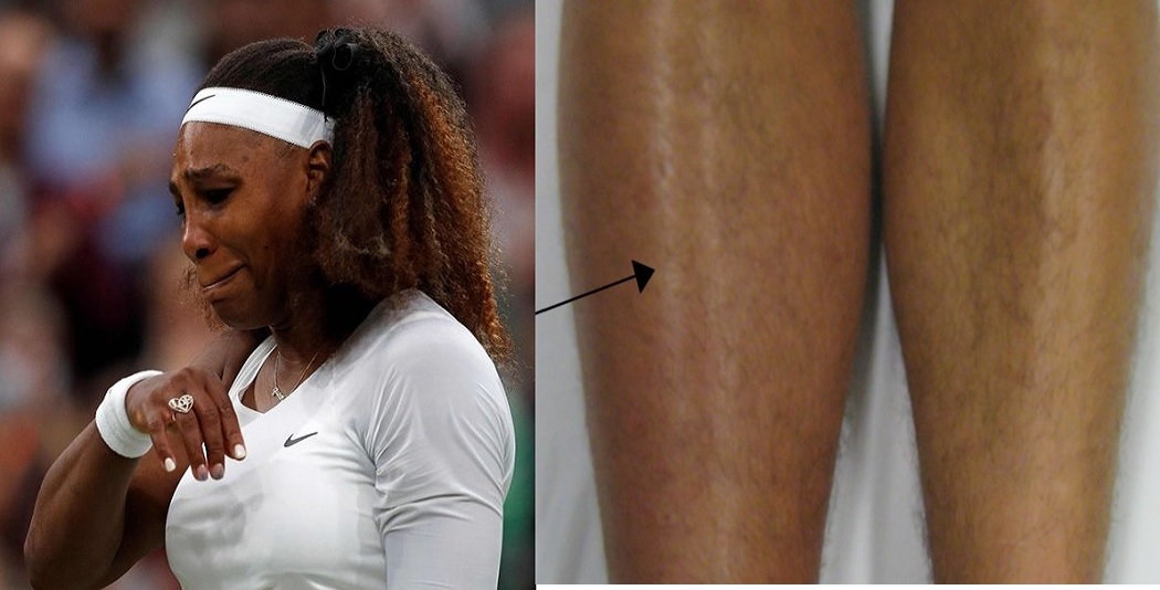 Serena Williams has not played since Wimbledon, when she retired from her first-round match with a leg injury.